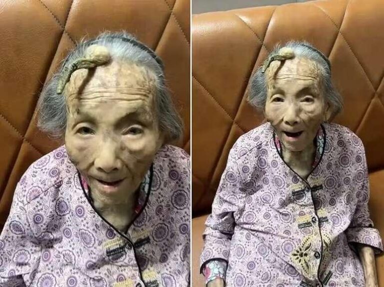 Idosa de 107 anos choca internautas ao mostrar ‘chifre’ de 10 cm na testa