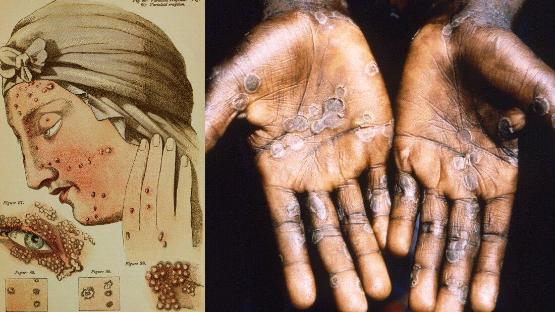 Ilustração de pústulas da varíola e pacientes com mpox