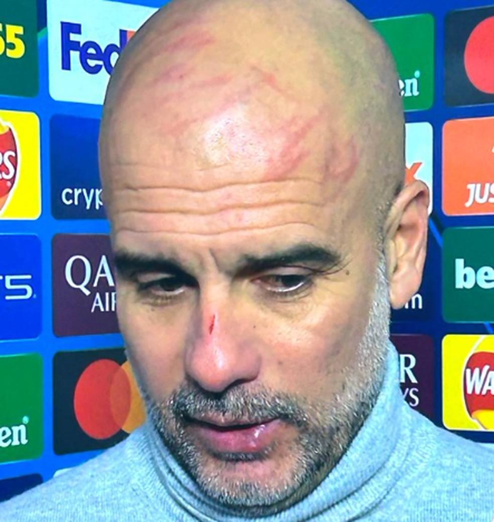 Pep Guardiola com um corte no nariz e arranhões na cabeça