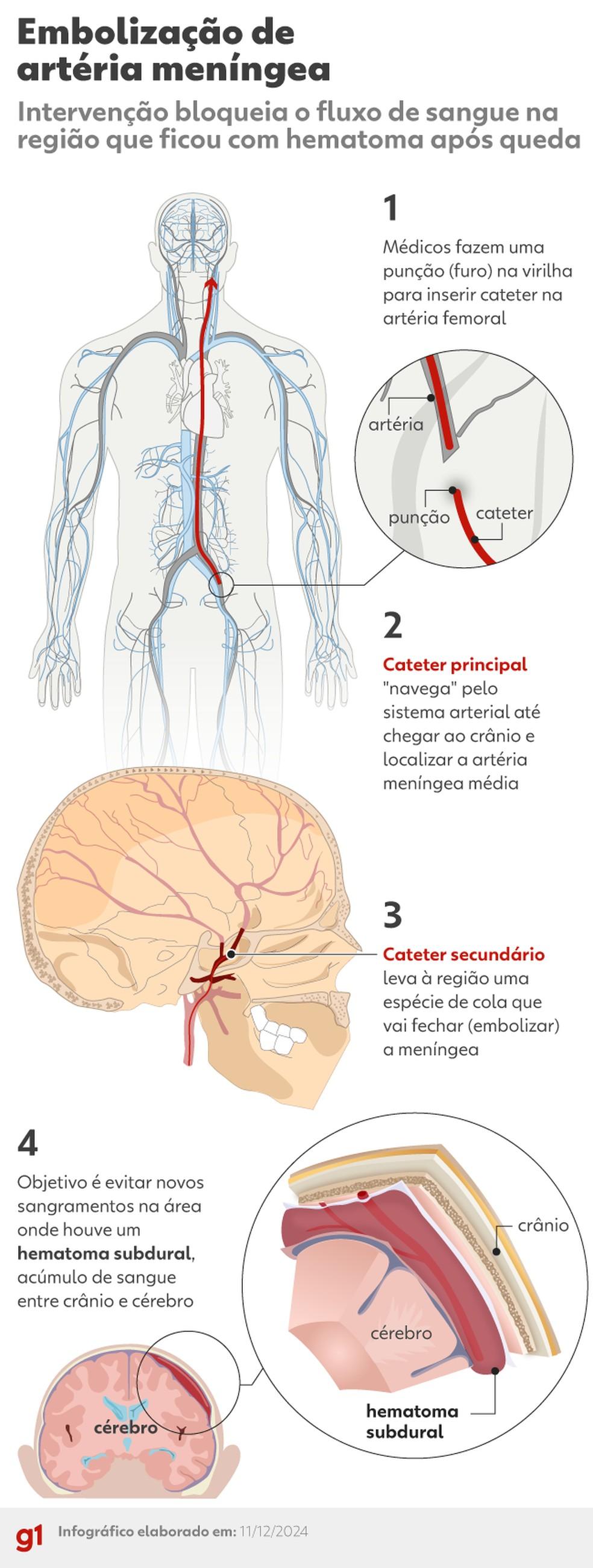 Embolização de artéria meníngea média