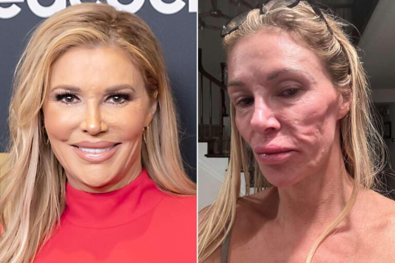 Brandi Glanville revela despesas de $70 mil em busca de cura para “parasita” facial