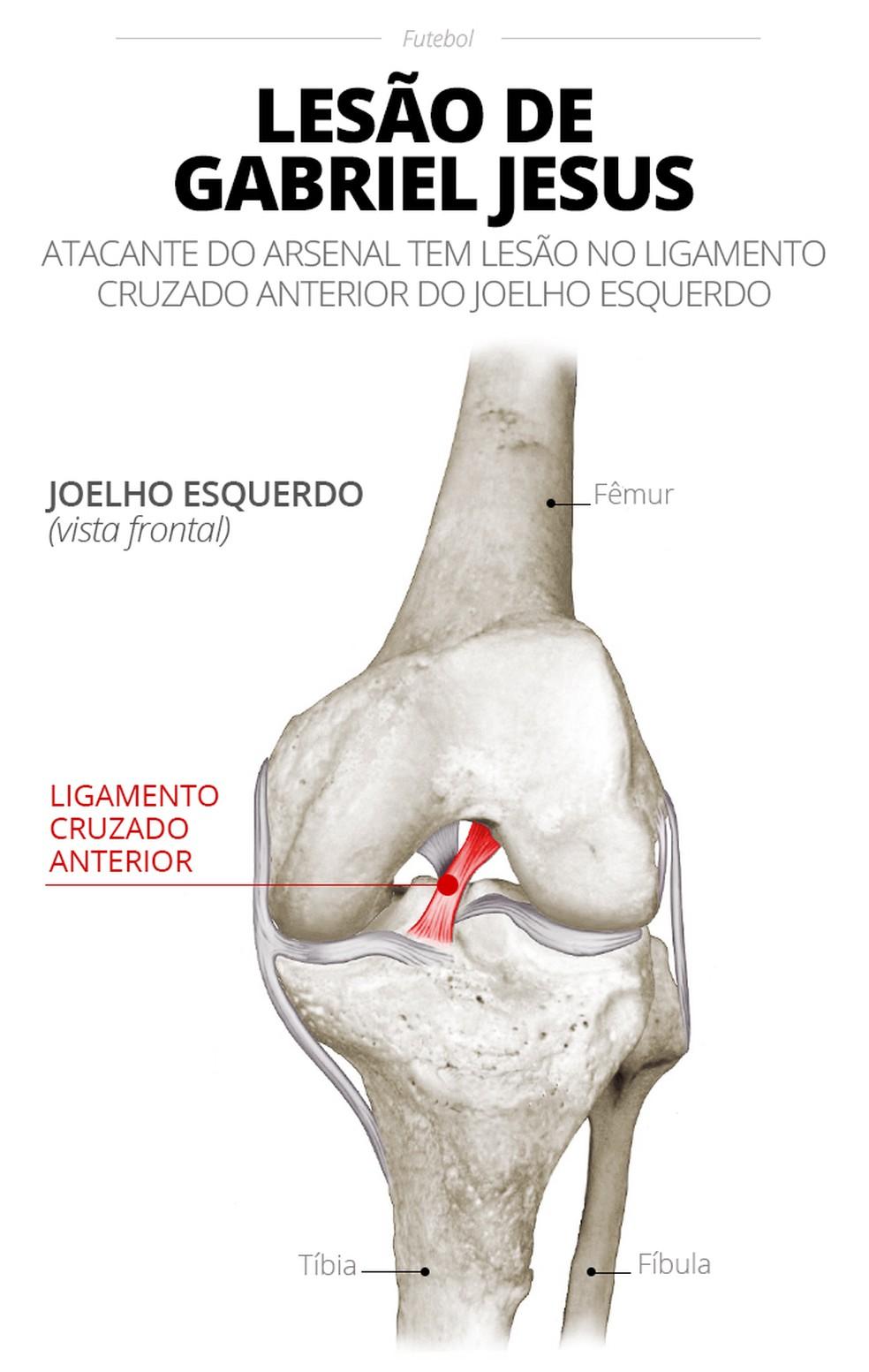 Entenda a lesão de Gabriel Jesus