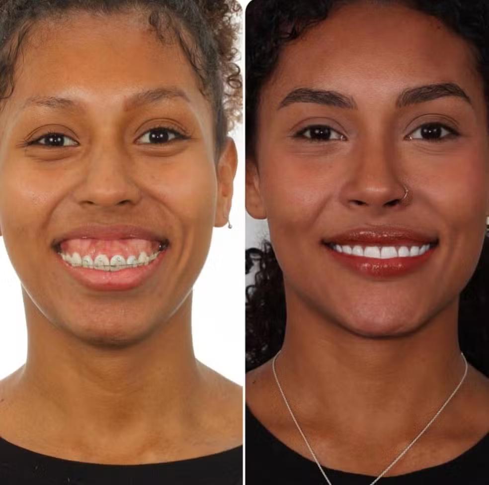 O antes e depois de Giovanna