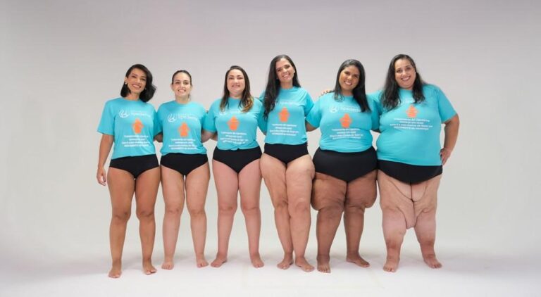 Lipedema: Entenda a Doença que Afeta Milhões de Mulheres e os Tratamentos Disponíveis