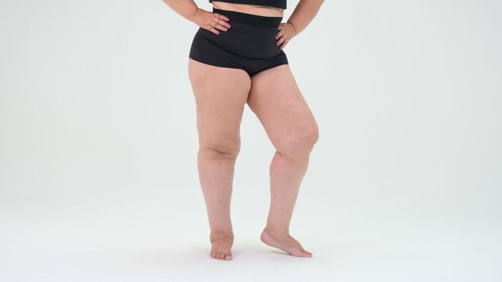 Mulher com lipedema