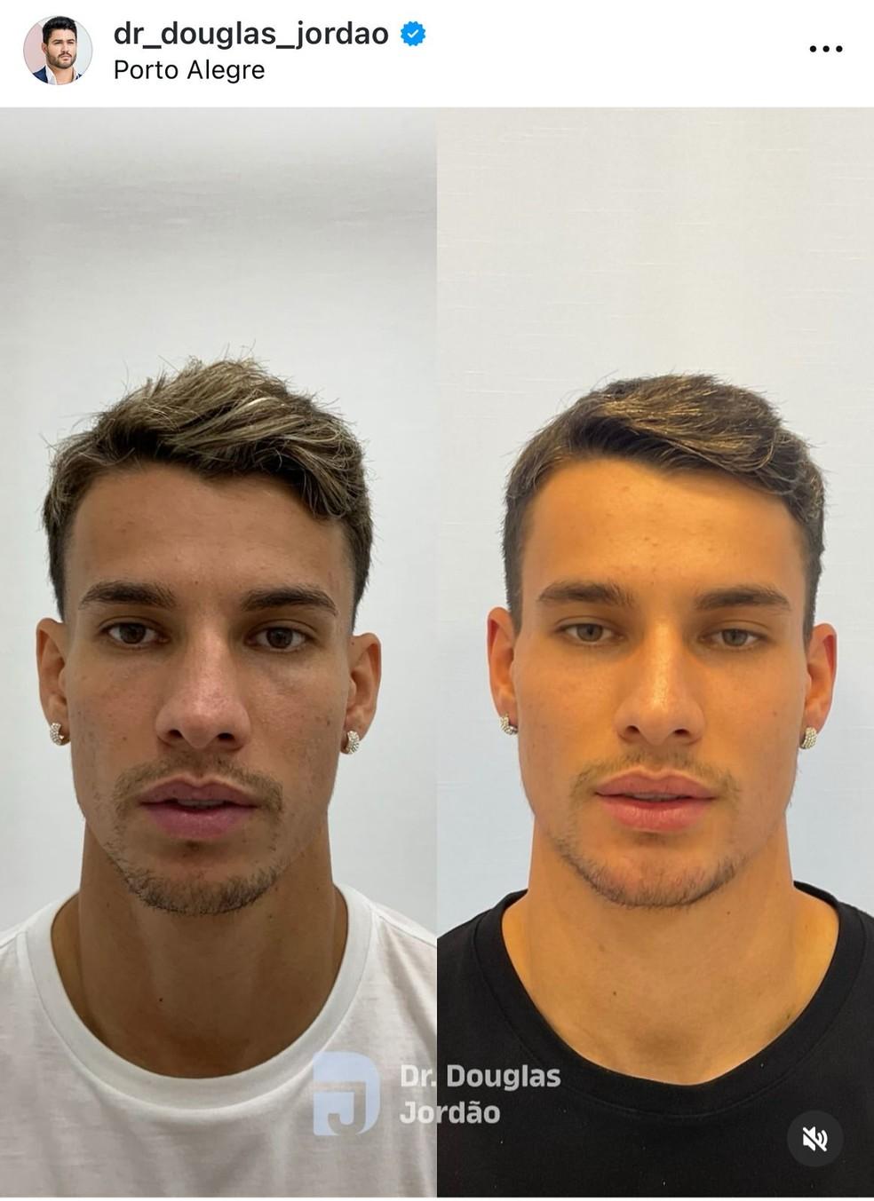 Ferreirinha, do São Paulo, após harmonização facial — Foto: Reprodução.