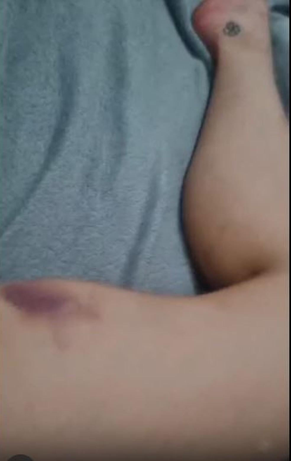 A advogada Larissa Ferrari mostrou hematomas pelo corpo ao acusar Dimitri Payet, do Vasco, de agressão