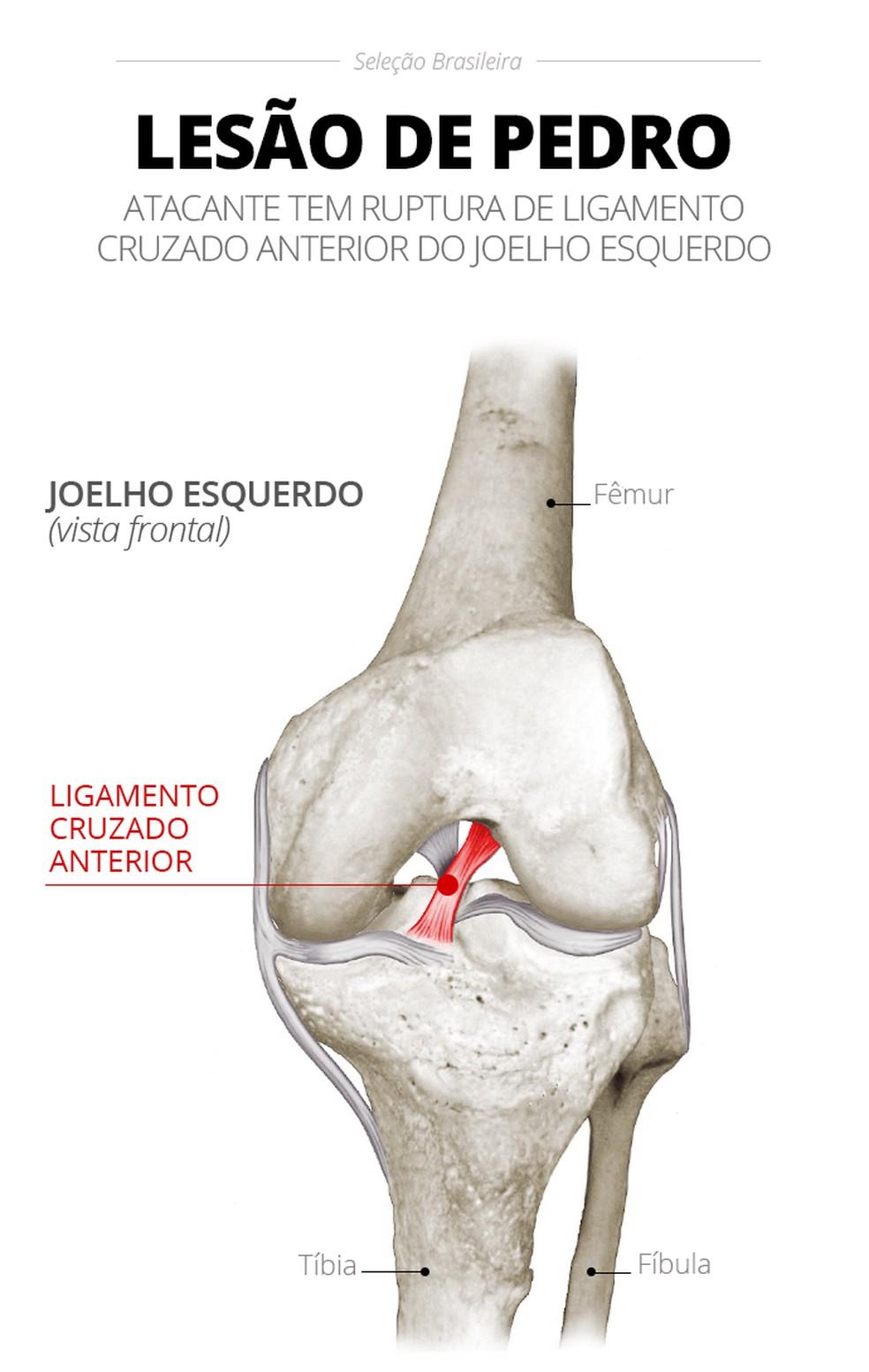 Gráfico da lesão de Pedro