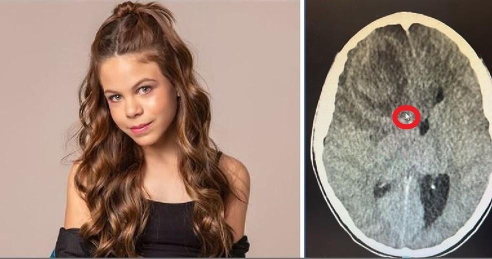Millena Brandão tinha 11 anos; ao lado foto do exame onde seta do mouse circundada em vermelho mostra mancha suspeita de ser um tumor no cérebro da atriz, segundo a família