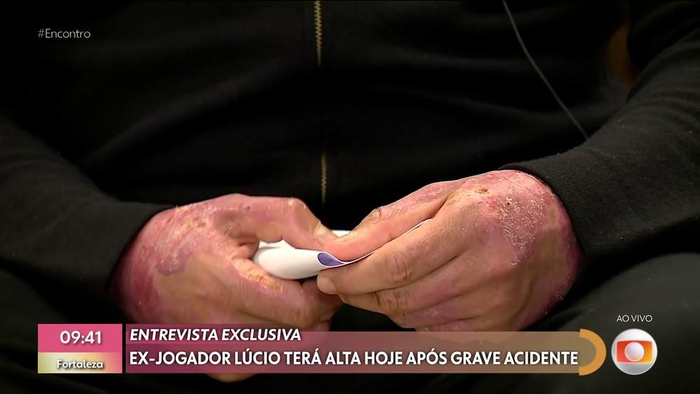 Lúcio aparece com mãos queimadas no Encontro