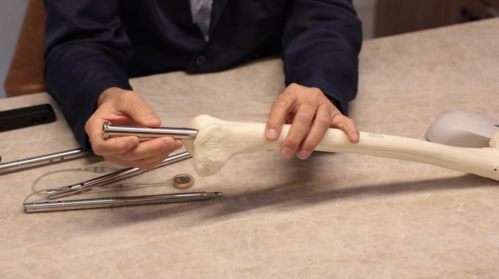 Alongamento ósseo: cirurgia que coloca haste eletrônica dentro do osso