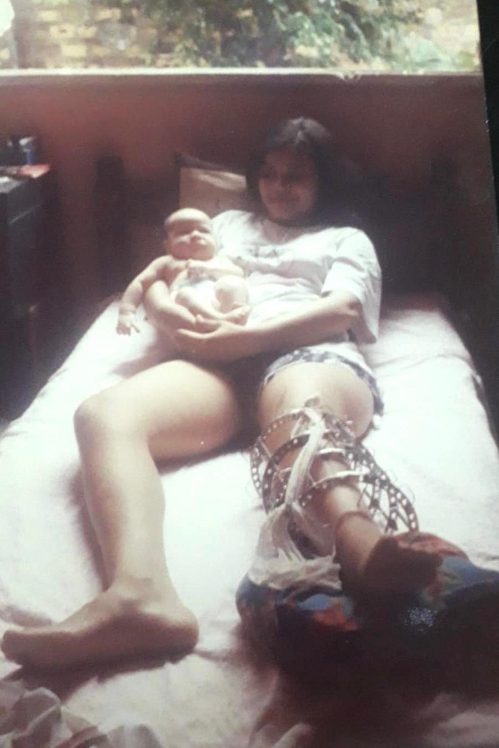 Pedagoga usou alongamento tradicional com 'gaiola' e diz que tratamento foi difícil