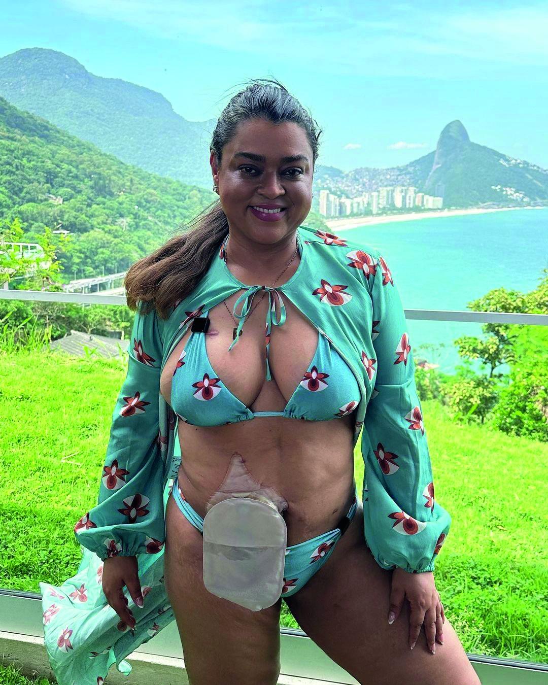 Preta Gil com a bolsa de ileostomia