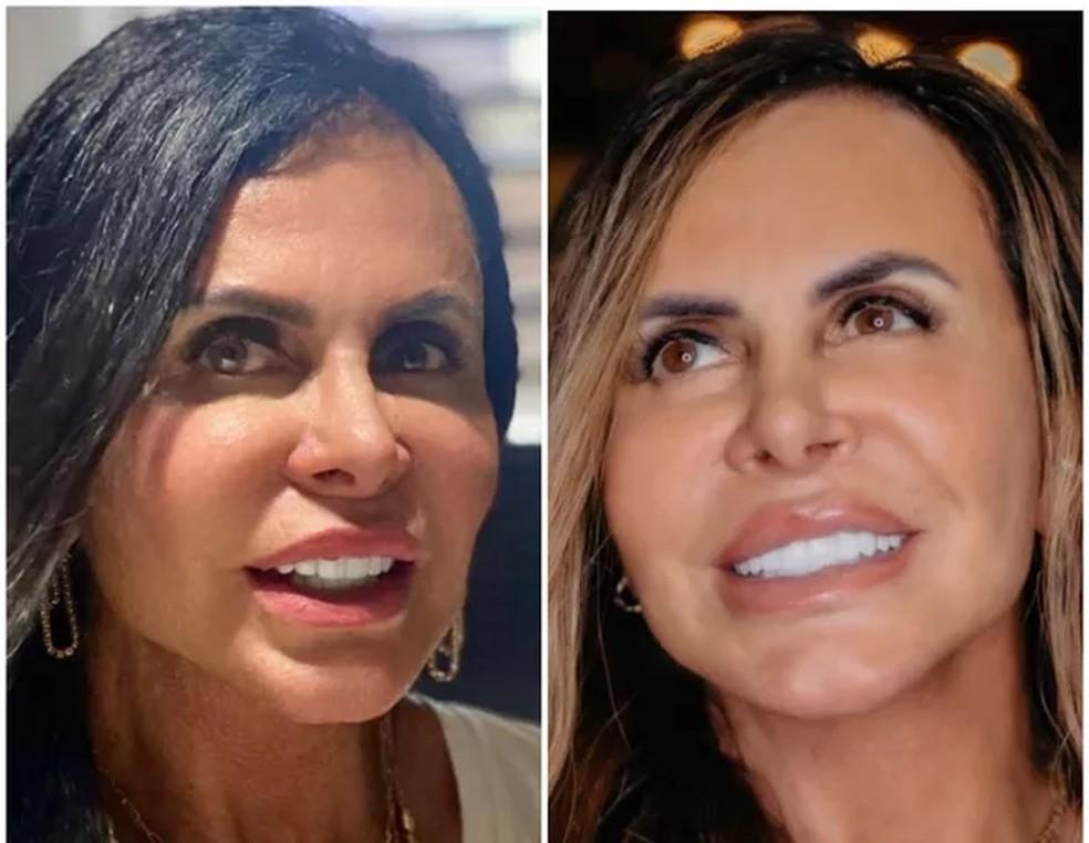Gretchen antes e depois da cobertura das olheiras