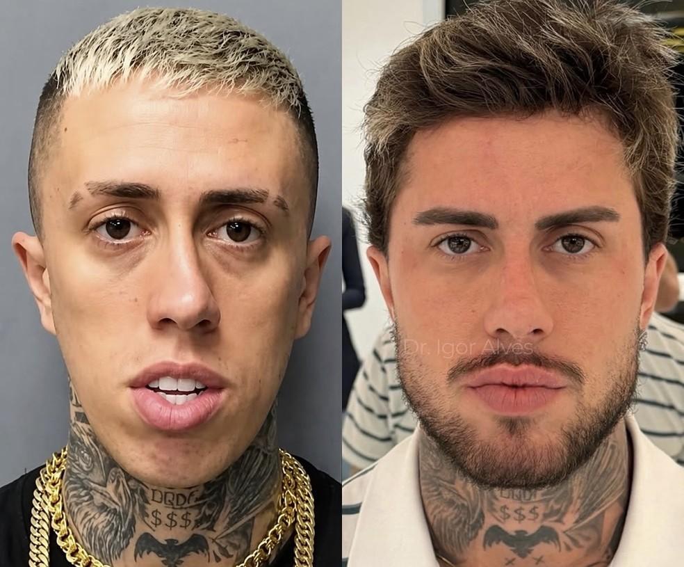 MC Daniel mostra transformação no rosto após procedimentos estéticos