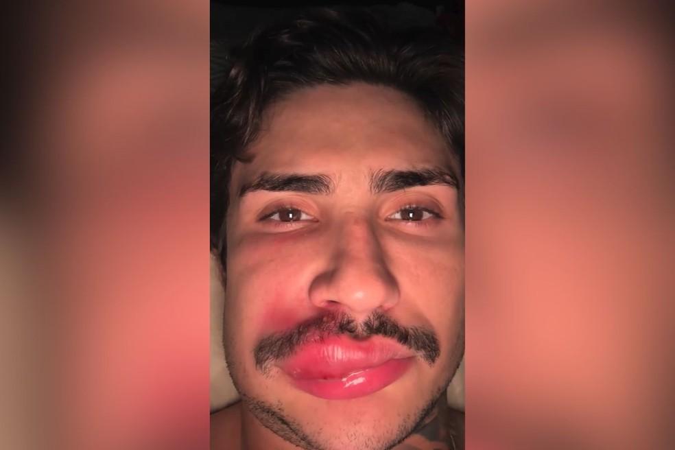 Influenciador de Campo Grande chegou a ser hospitalizado após infecção e alertou os seguidores.