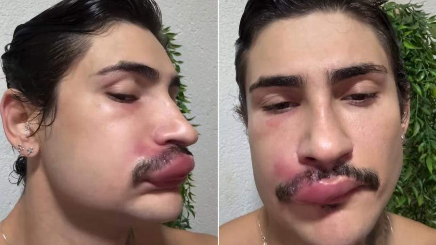 O influenciador Ken de CG que teve os lábios infeccionados após espremer uma espinha.