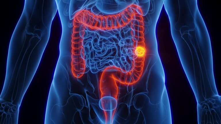 Câncer de Intestino: Pesquisa Revela Conhecimento e Falta de Ação Entre Brasileiros
